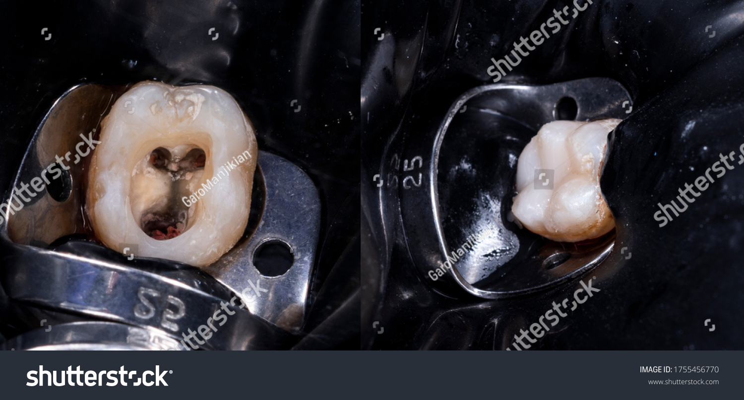 Root Canal Treatment